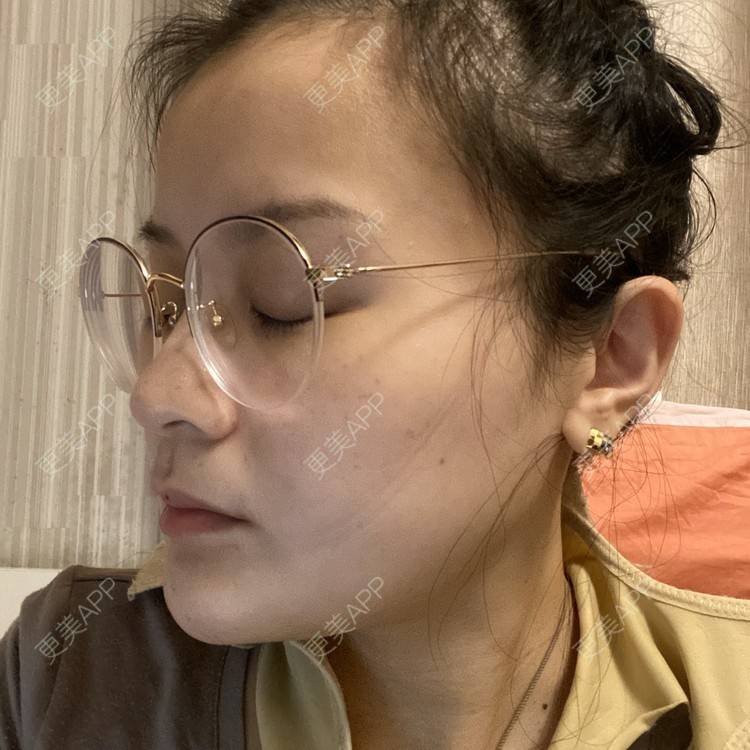 更美 - 一白遮三丑丑丑的吸脂瘦脸经验 | 吸脂瘦脸 | 射频溶脂 | 激光溶脂瘦脸 | 上海