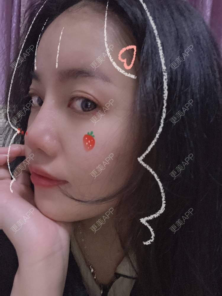 更美 - Dd酱哦的隆鼻经验 | 耳软骨隆鼻 | 硅胶隆鼻 | 隆鼻 | 鼻部多项 | 自体软骨垫鼻尖 | 温州