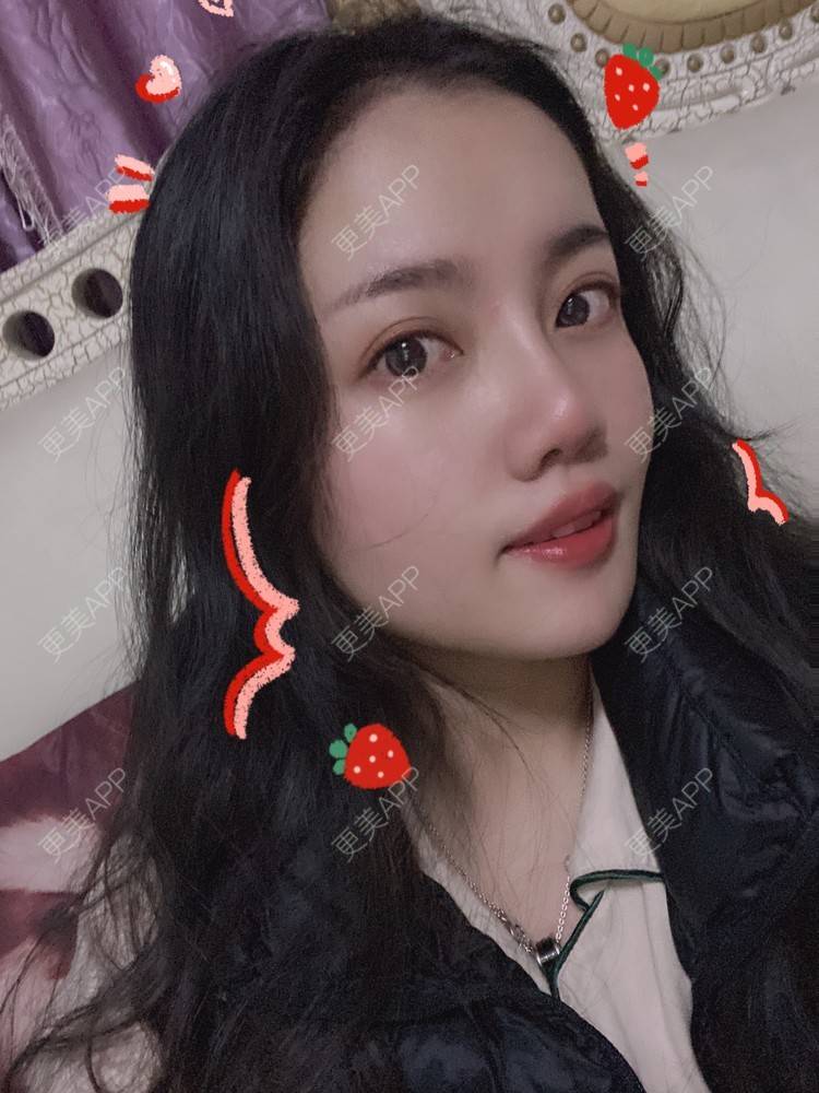 更美 - Dd酱哦的隆鼻经验 | 耳软骨隆鼻 | 硅胶隆鼻 | 隆鼻 | 鼻部多项 | 自体软骨垫鼻尖 | 温州