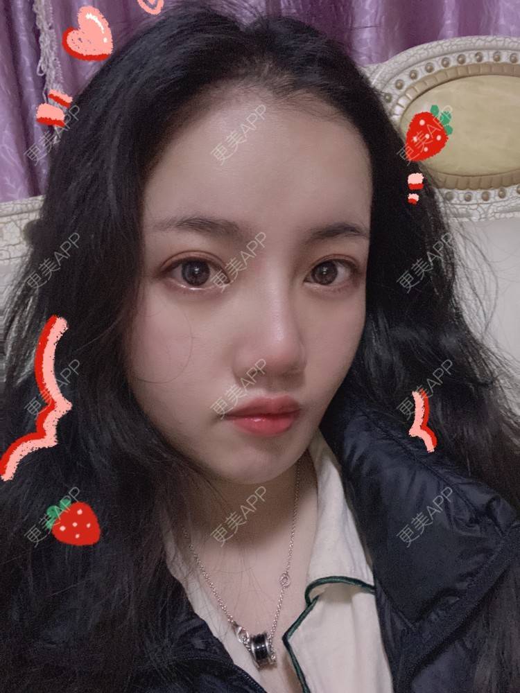更美 - Dd酱哦的隆鼻经验 | 耳软骨隆鼻 | 硅胶隆鼻 | 隆鼻 | 鼻部多项 | 自体软骨垫鼻尖 | 温州