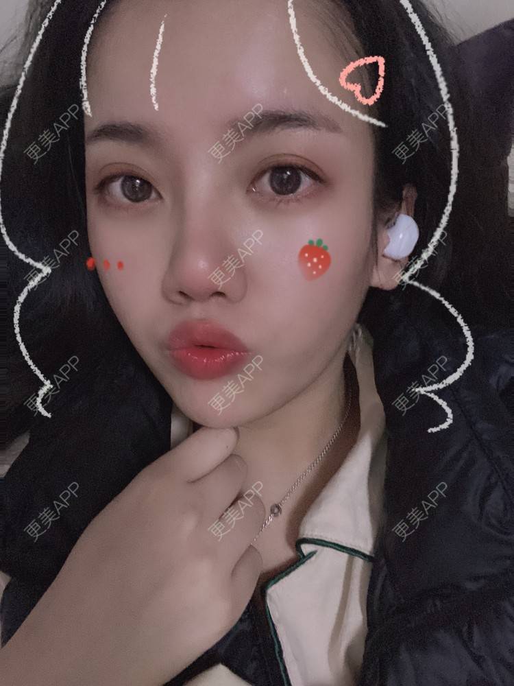 更美 - Dd酱哦的隆鼻经验 | 耳软骨隆鼻 | 硅胶隆鼻 | 隆鼻 | 鼻部多项 | 自体软骨垫鼻尖 | 温州