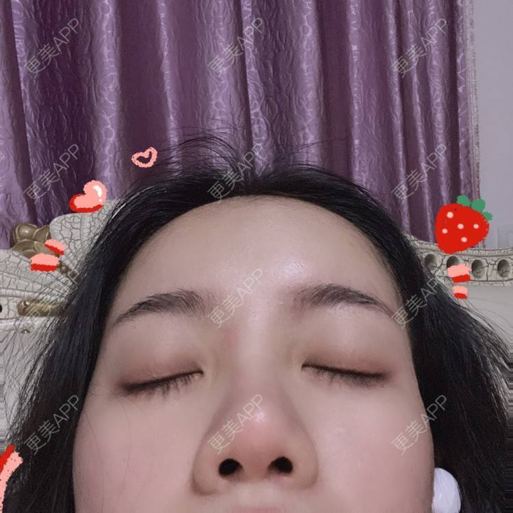 更美 - Dd酱哦的隆鼻经验 | 耳软骨隆鼻 | 硅胶隆鼻 | 隆鼻 | 鼻部多项 | 自体软骨垫鼻尖 | 温州