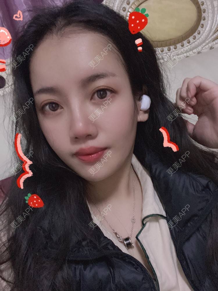 更美 - Dd酱哦的隆鼻经验 | 耳软骨隆鼻 | 硅胶隆鼻 | 隆鼻 | 鼻部多项 | 自体软骨垫鼻尖 | 温州