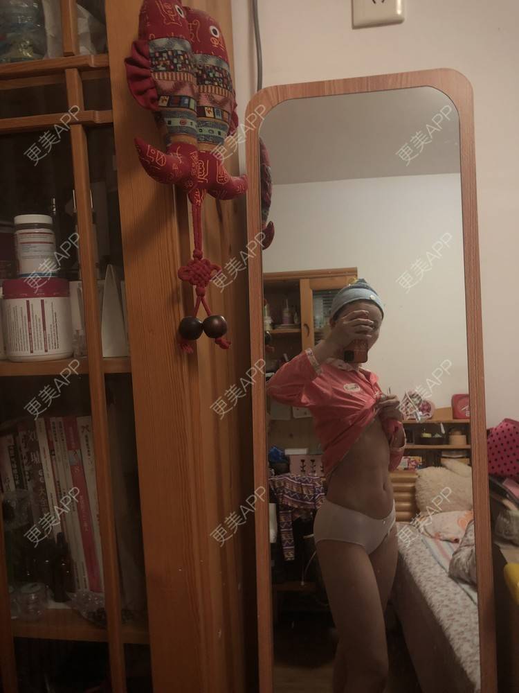 更美 - XXX||XXX的腰腹吸脂经验 | 腰腹吸脂 | 背部吸脂 | 手臂吸脂 | 郑州