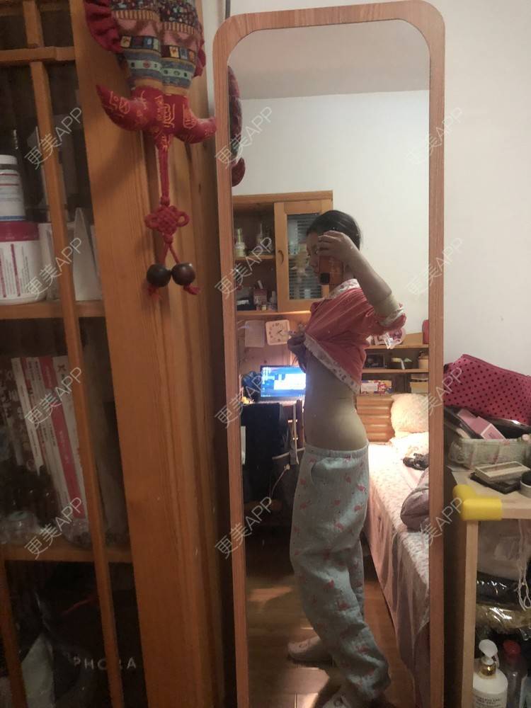 更美 - XXX||XXX的腰腹吸脂经验 | 腰腹吸脂 | 背部吸脂 | 手臂吸脂 | 郑州
