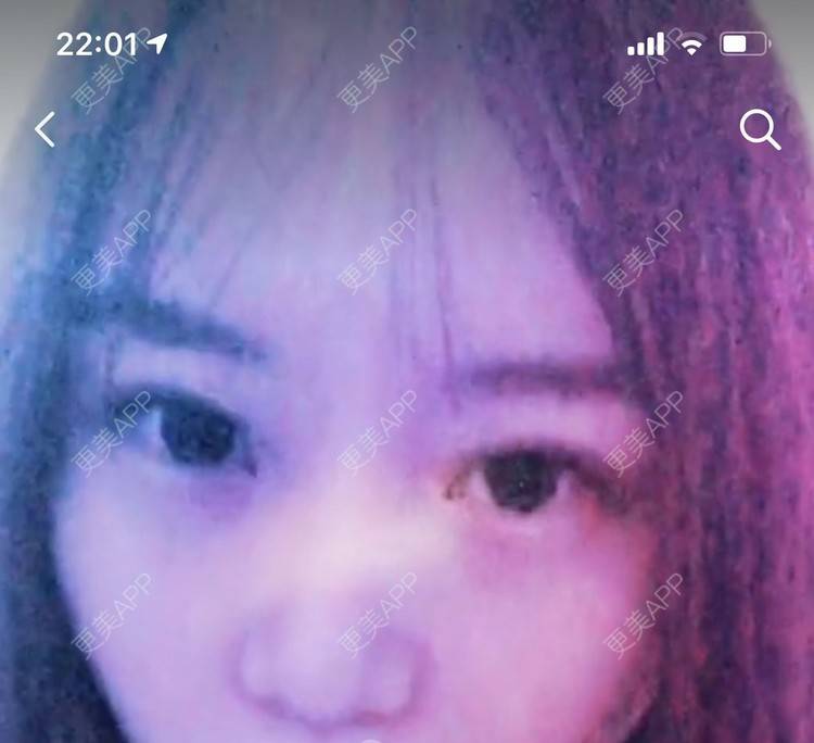 更美 - 圆方脸课代表ʚ😊ɞ的隆鼻经验 | 隆鼻 | 假体垫鼻基底 | 鼻部多项 | 全切双眼皮 | 自体软骨垫鼻尖 | 硅胶隆鼻 | 南京 | 耳软骨隆鼻 | 视频日记