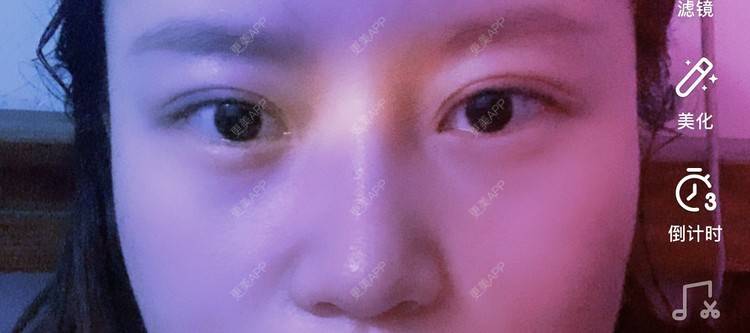 更美 - 圆方脸课代表ʚ😊ɞ的隆鼻经验 | 隆鼻 | 假体垫鼻基底 | 鼻部多项 | 全切双眼皮 | 自体软骨垫鼻尖 | 硅胶隆鼻 | 南京 | 耳软骨隆鼻 | 视频日记