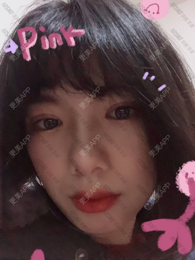 更美 - 无辣不欢但不要太辣的全切双眼皮经验 | 视频日记 | 全切双眼皮 | 开内眼角 | 上眼睑去脂 | 眼部多项 | 长沙
