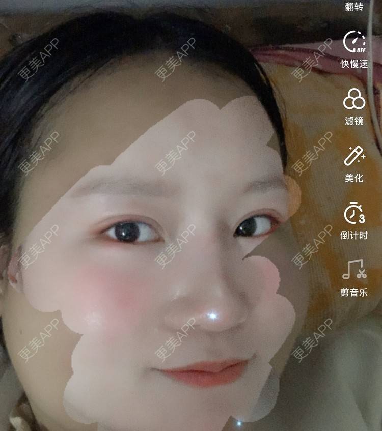 更美 - 圆方脸课代表ʚ😊ɞ的隆鼻经验 | 隆鼻 | 假体垫鼻基底 | 鼻部多项 | 全切双眼皮 | 自体软骨垫鼻尖 | 硅胶隆鼻 | 南京 | 耳软骨隆鼻 | 视频日记