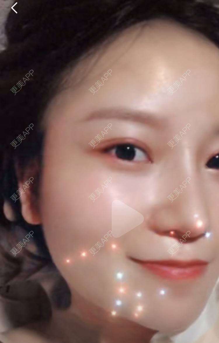 更美 - 圆方脸课代表ʚ😊ɞ的隆鼻经验 | 隆鼻 | 假体垫鼻基底 | 鼻部多项 | 全切双眼皮 | 自体软骨垫鼻尖 | 硅胶隆鼻 | 南京 | 耳软骨隆鼻 | 视频日记