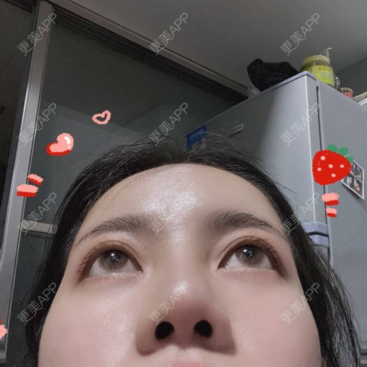 更美 - Dd酱哦的隆鼻经验 | 耳软骨隆鼻 | 硅胶隆鼻 | 隆鼻 | 鼻部多项 | 自体软骨垫鼻尖 | 温州