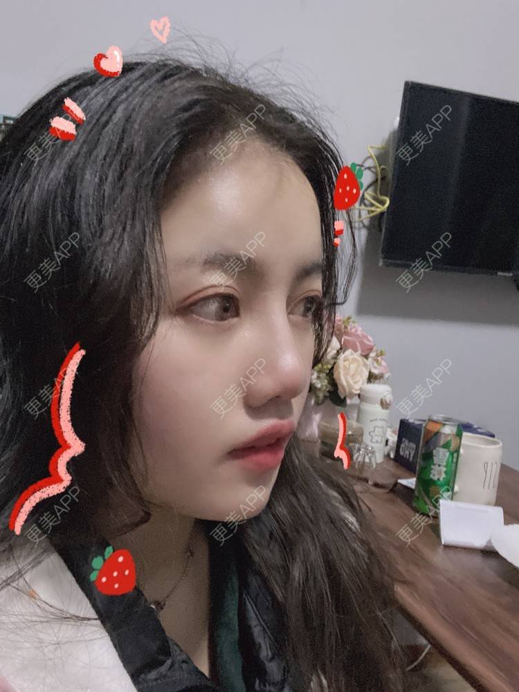 更美 - Dd酱哦的隆鼻经验 | 耳软骨隆鼻 | 硅胶隆鼻 | 隆鼻 | 鼻部多项 | 自体软骨垫鼻尖 | 温州