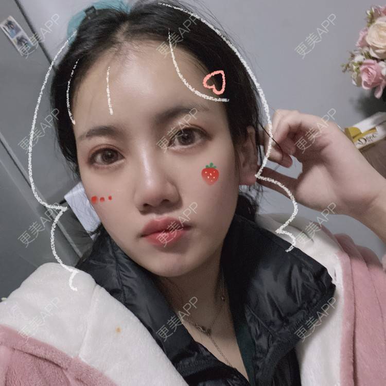 更美 - Dd酱哦的隆鼻经验 | 耳软骨隆鼻 | 硅胶隆鼻 | 隆鼻 | 鼻部多项 | 自体软骨垫鼻尖 | 温州
