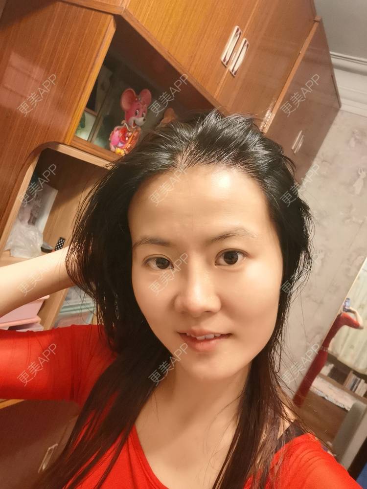 更美 - umgsd的植发际线经验 | 植发际线 | 上海