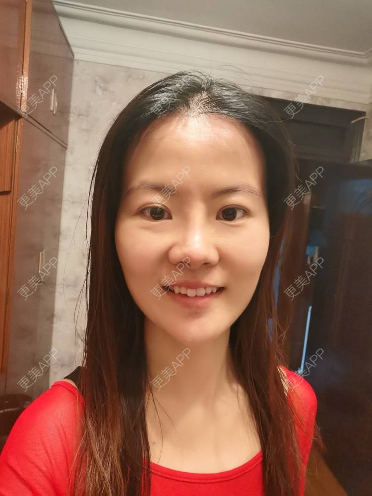 更美 - umgsd的植发际线经验 | 植发际线 | 上海