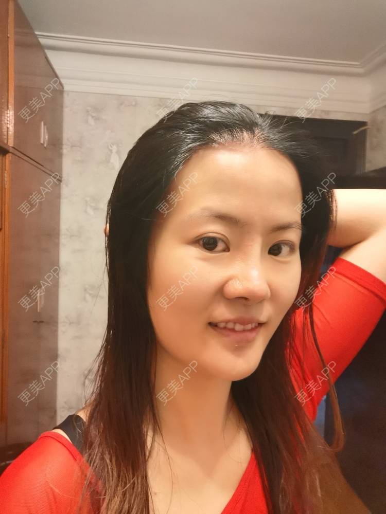 更美 - umgsd的植发际线经验 | 植发际线 | 上海