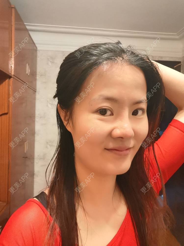 更美 - umgsd的植发际线经验 | 植发际线 | 上海