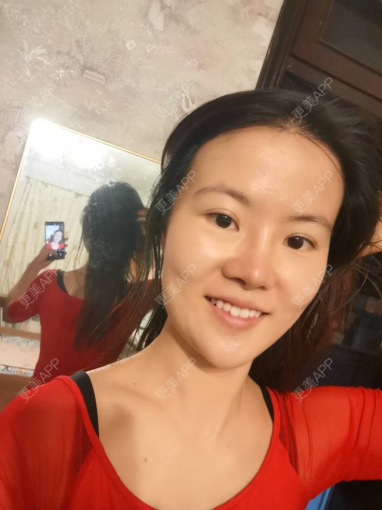 更美 - umgsd的植发际线经验 | 植发际线 | 上海