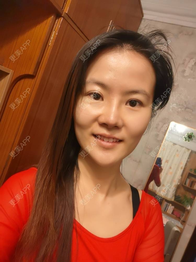 更美 - umgsd的植发际线经验 | 植发际线 | 上海