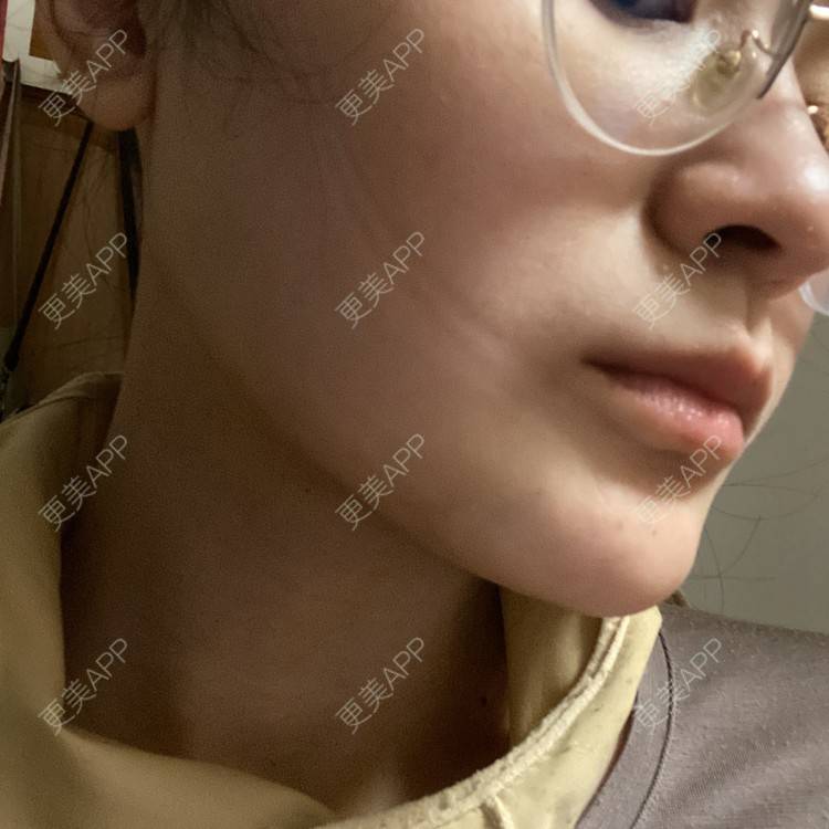 更美 - 一白遮三丑丑丑的吸脂瘦脸经验 | 吸脂瘦脸 | 激光溶脂瘦脸 | 上海 | 射频溶脂
