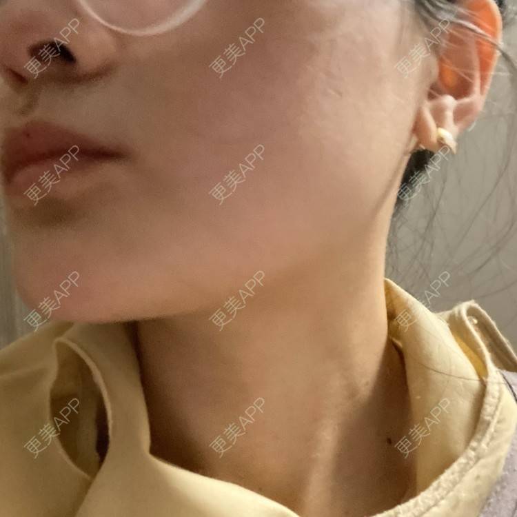 更美 - 一白遮三丑丑丑的吸脂瘦脸经验 | 吸脂瘦脸 | 激光溶脂瘦脸 | 上海 | 射频溶脂