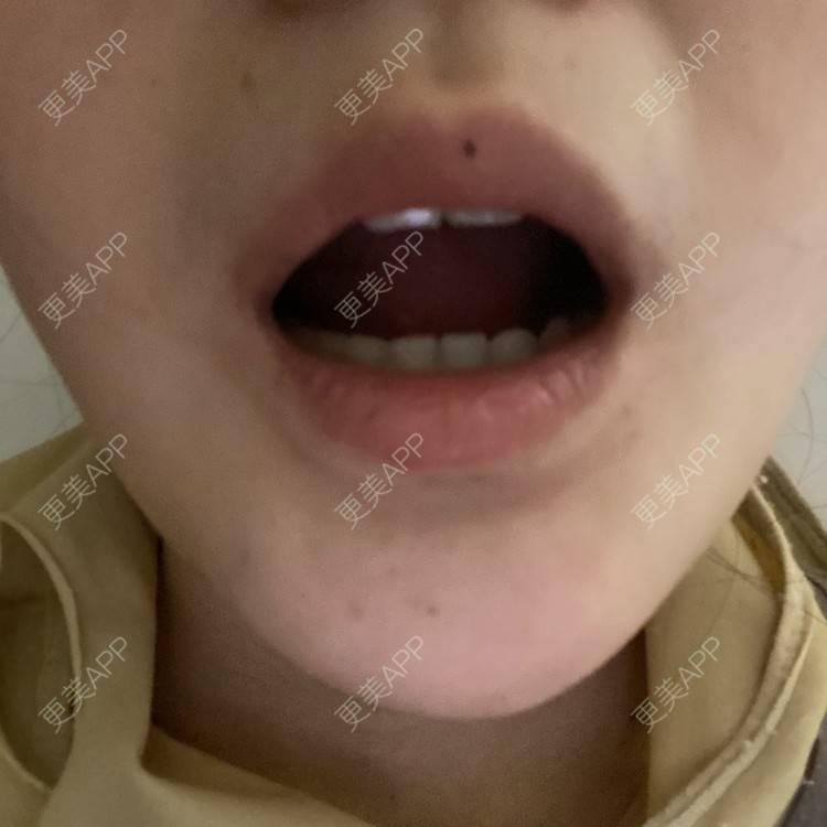 更美 - 一白遮三丑丑丑的吸脂瘦脸经验 | 吸脂瘦脸 | 激光溶脂瘦脸 | 上海 | 射频溶脂