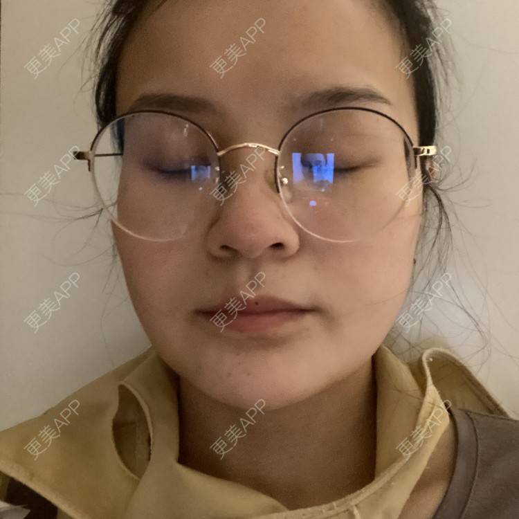 更美 - 一白遮三丑丑丑的吸脂瘦脸经验 | 吸脂瘦脸 | 激光溶脂瘦脸 | 上海 | 射频溶脂