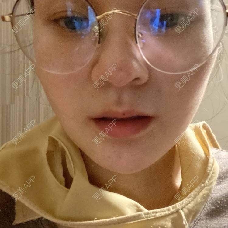 更美 - 一白遮三丑丑丑的吸脂瘦脸经验 | 吸脂瘦脸 | 激光溶脂瘦脸 | 上海 | 射频溶脂