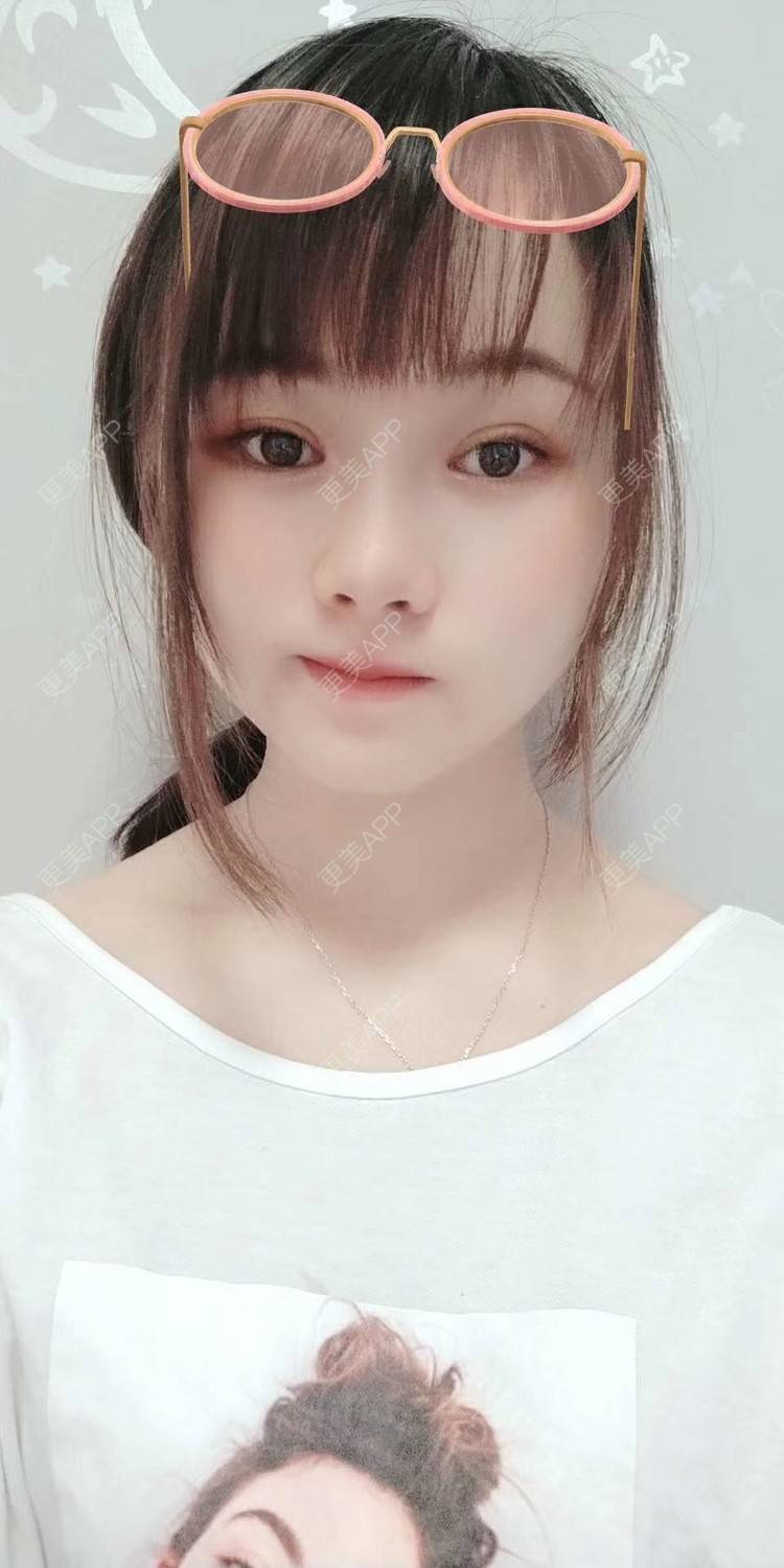 更美 - 米连菊 医生的玻尿酸鼻部经验 | 广州 | 玻尿酸鼻部