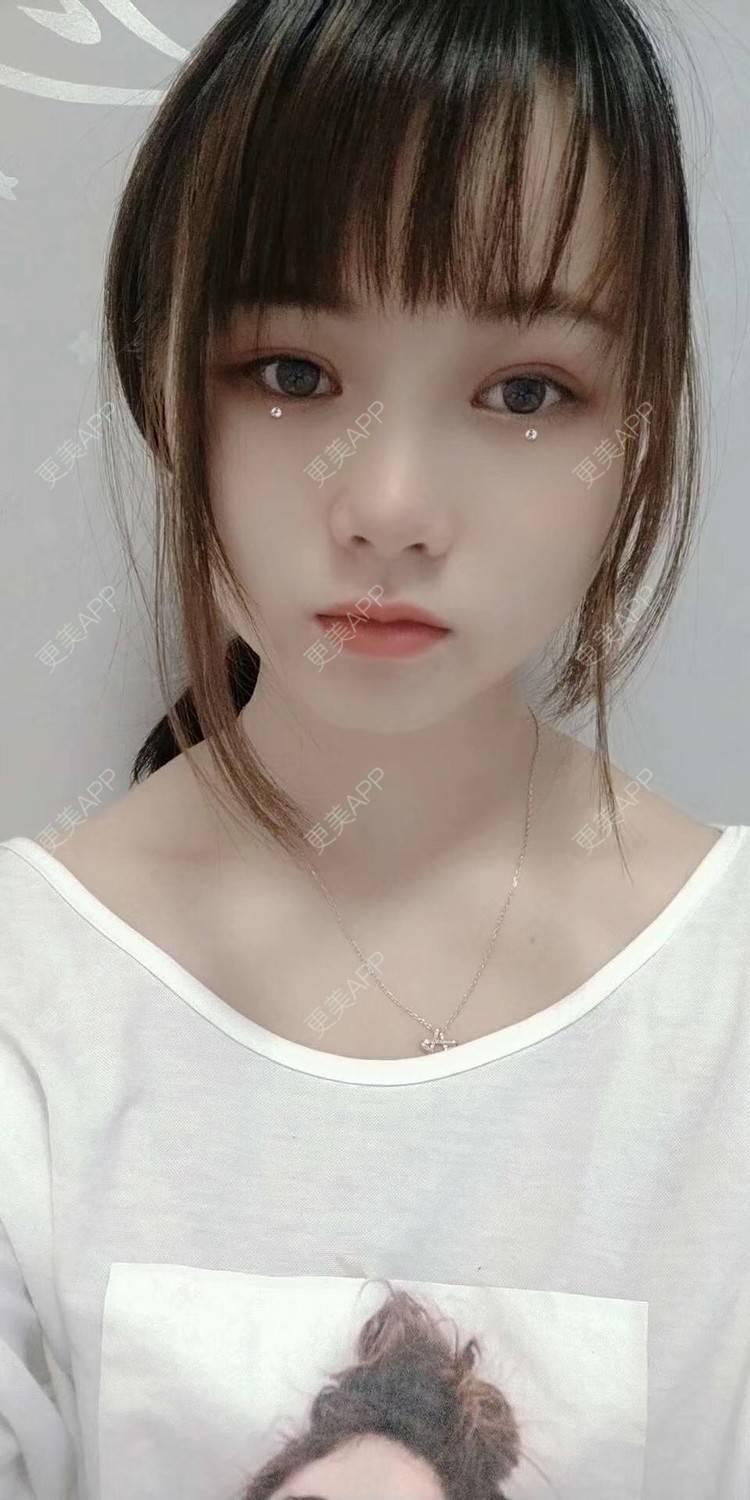 更美 - 米连菊 医生的玻尿酸鼻部经验 | 广州 | 玻尿酸鼻部