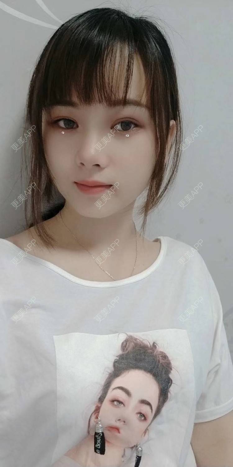 更美 - 米连菊 医生的玻尿酸鼻部经验 | 广州 | 玻尿酸鼻部
