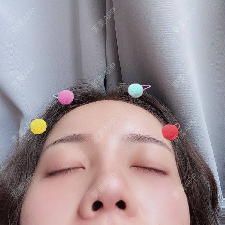 更美 - Dd酱哦的隆鼻经验 | 耳软骨隆鼻 | 硅胶隆鼻 | 隆鼻 | 鼻部多项 | 自体软骨垫鼻尖 | 温州