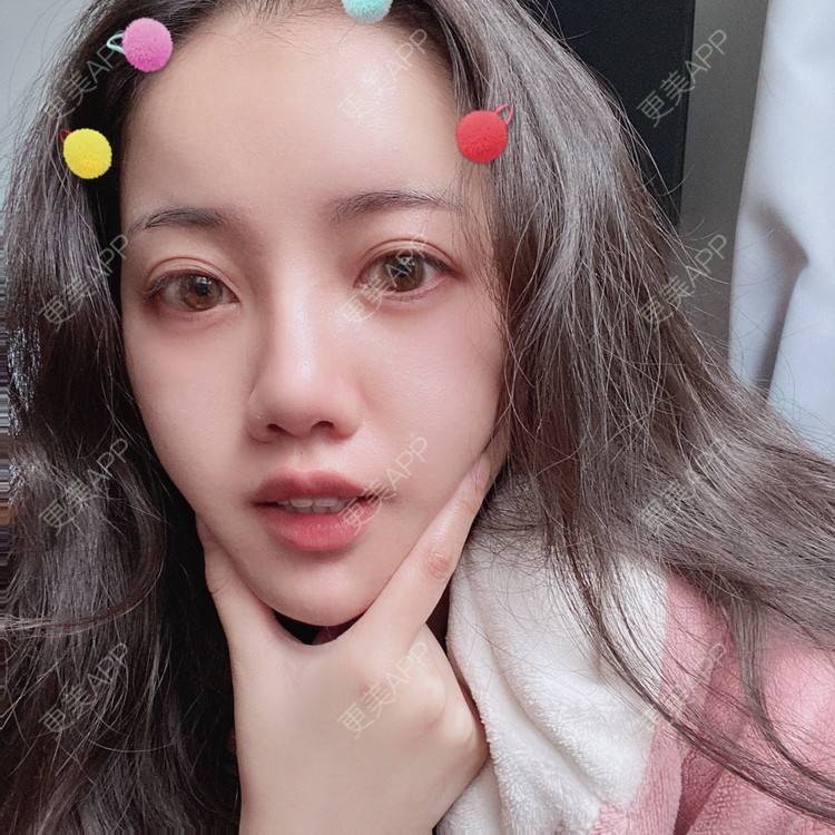 更美 - Dd酱哦的隆鼻经验 | 耳软骨隆鼻 | 硅胶隆鼻 | 隆鼻 | 鼻部多项 | 自体软骨垫鼻尖 | 温州