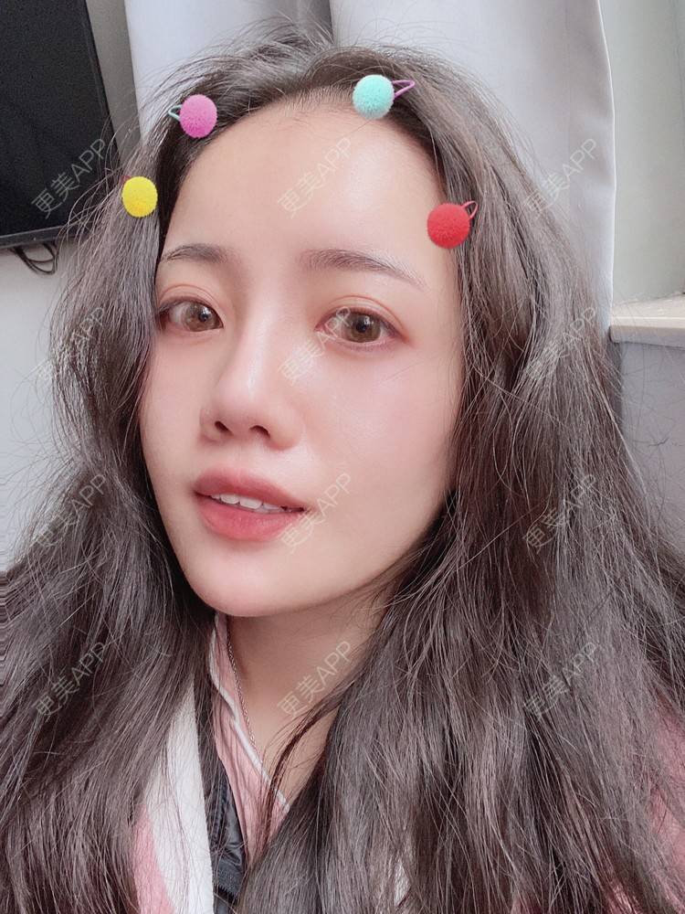 更美 - Dd酱哦的隆鼻经验 | 耳软骨隆鼻 | 硅胶隆鼻 | 隆鼻 | 鼻部多项 | 自体软骨垫鼻尖 | 温州