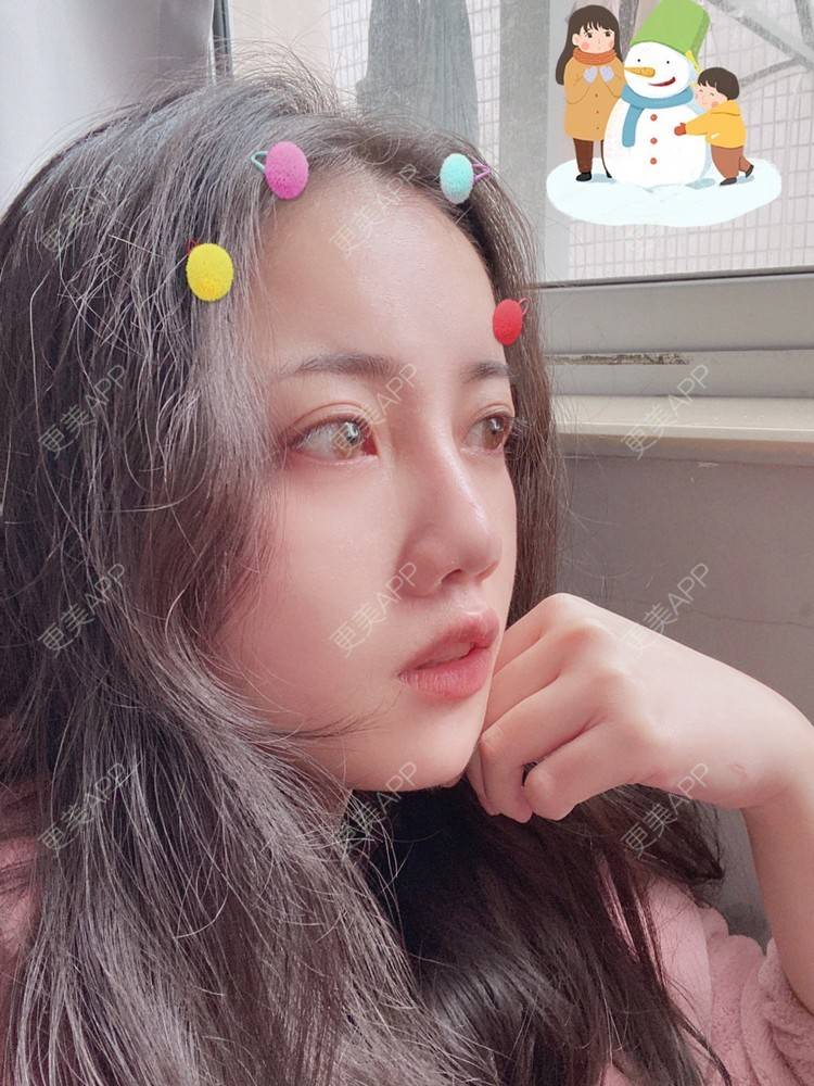 更美 - Dd酱哦的隆鼻经验 | 耳软骨隆鼻 | 硅胶隆鼻 | 隆鼻 | 鼻部多项 | 自体软骨垫鼻尖 | 温州
