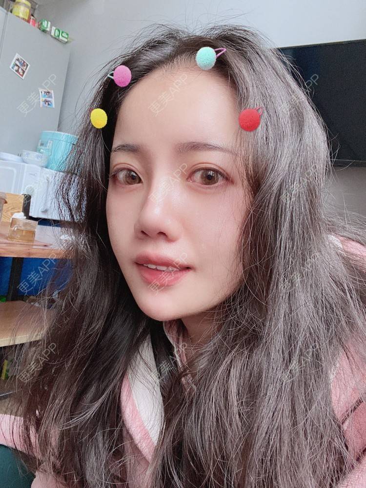 更美 - Dd酱哦的隆鼻经验 | 耳软骨隆鼻 | 硅胶隆鼻 | 隆鼻 | 鼻部多项 | 自体软骨垫鼻尖 | 温州