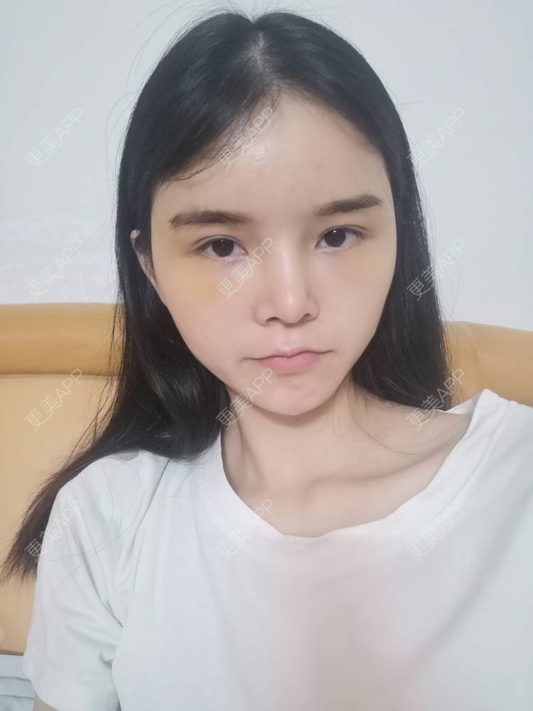 更美 - 莫宁🌸的自体脂肪填充泪沟经验 | 自体脂肪丰额头 | 自体脂肪填充泪沟 | 自体脂肪丰苹果肌 | 自体脂肪丰面颊 | 自体脂肪丰太阳穴 | 自体脂肪垫下巴 | 广州 | 视频日记