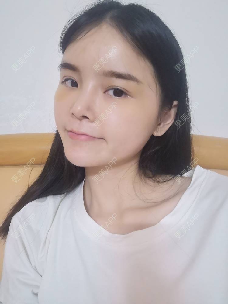 更美 - 莫宁🌸的自体脂肪填充泪沟经验 | 自体脂肪丰额头 | 自体脂肪填充泪沟 | 自体脂肪丰苹果肌 | 自体脂肪丰面颊 | 自体脂肪丰太阳穴 | 自体脂肪垫下巴 | 广州 | 视频日记