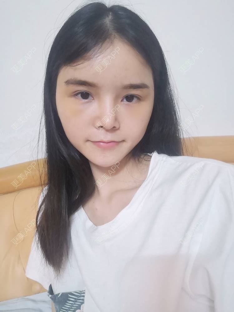 更美 - 莫宁🌸的自体脂肪填充泪沟经验 | 自体脂肪丰额头 | 自体脂肪填充泪沟 | 自体脂肪丰苹果肌 | 自体脂肪丰面颊 | 自体脂肪丰太阳穴 | 自体脂肪垫下巴 | 广州 | 视频日记