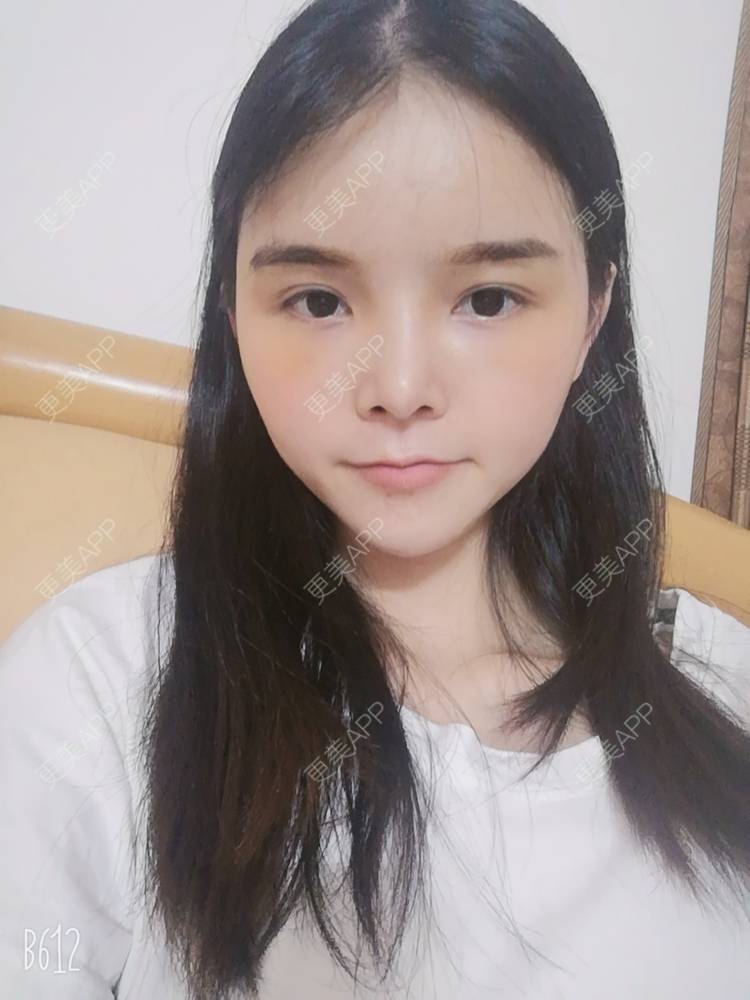 更美 - 莫宁🌸的自体脂肪填充泪沟经验 | 自体脂肪丰额头 | 自体脂肪填充泪沟 | 自体脂肪丰苹果肌 | 自体脂肪丰面颊 | 自体脂肪丰太阳穴 | 自体脂肪垫下巴 | 广州 | 视频日记