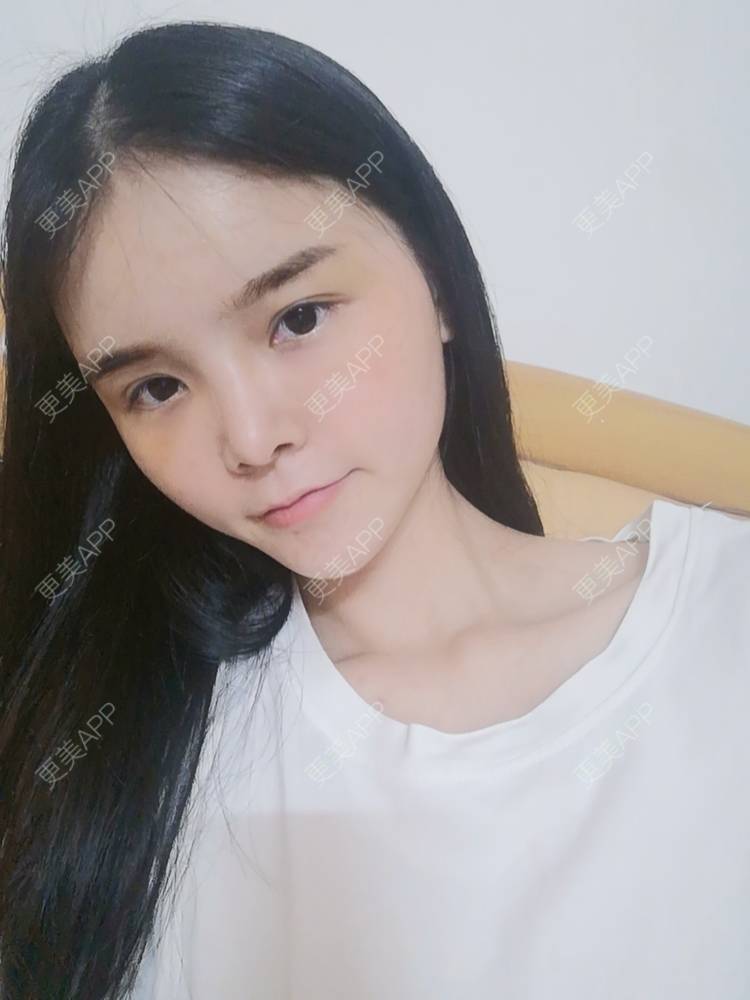 更美 - 莫宁🌸的自体脂肪填充泪沟经验 | 自体脂肪丰额头 | 自体脂肪填充泪沟 | 自体脂肪丰苹果肌 | 自体脂肪丰面颊 | 自体脂肪丰太阳穴 | 自体脂肪垫下巴 | 广州 | 视频日记