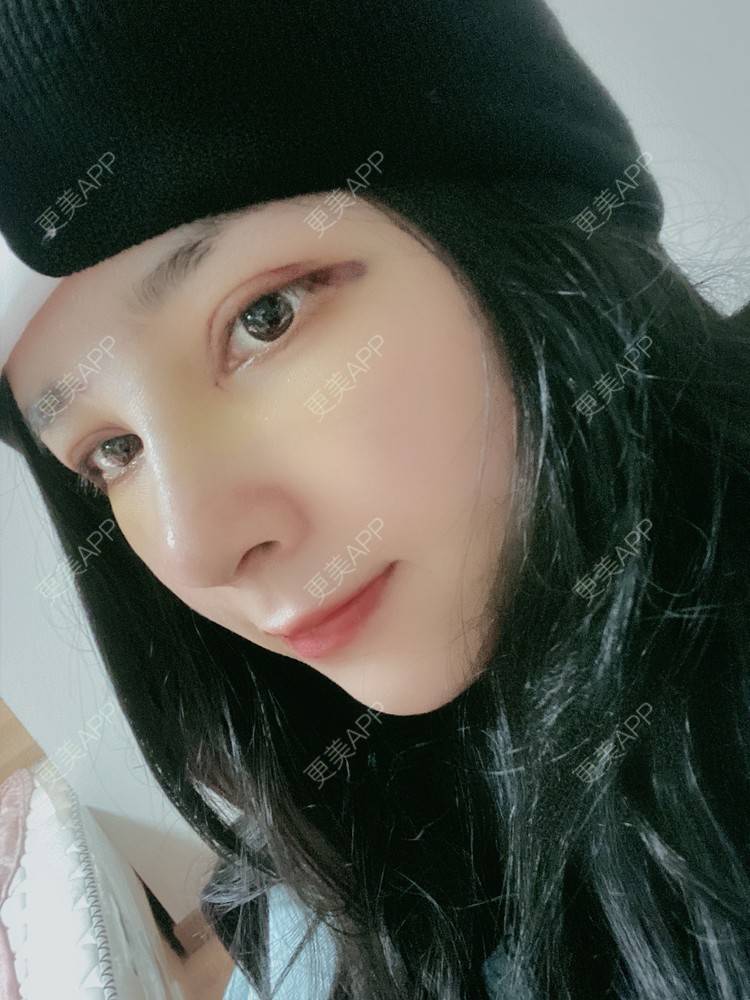 更美 - 崔老师的肋软骨隆鼻经验 | 肋软骨隆鼻 | 杭州