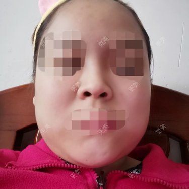 鼻部多项
