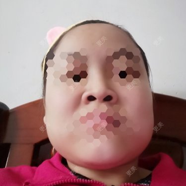 鼻部多项