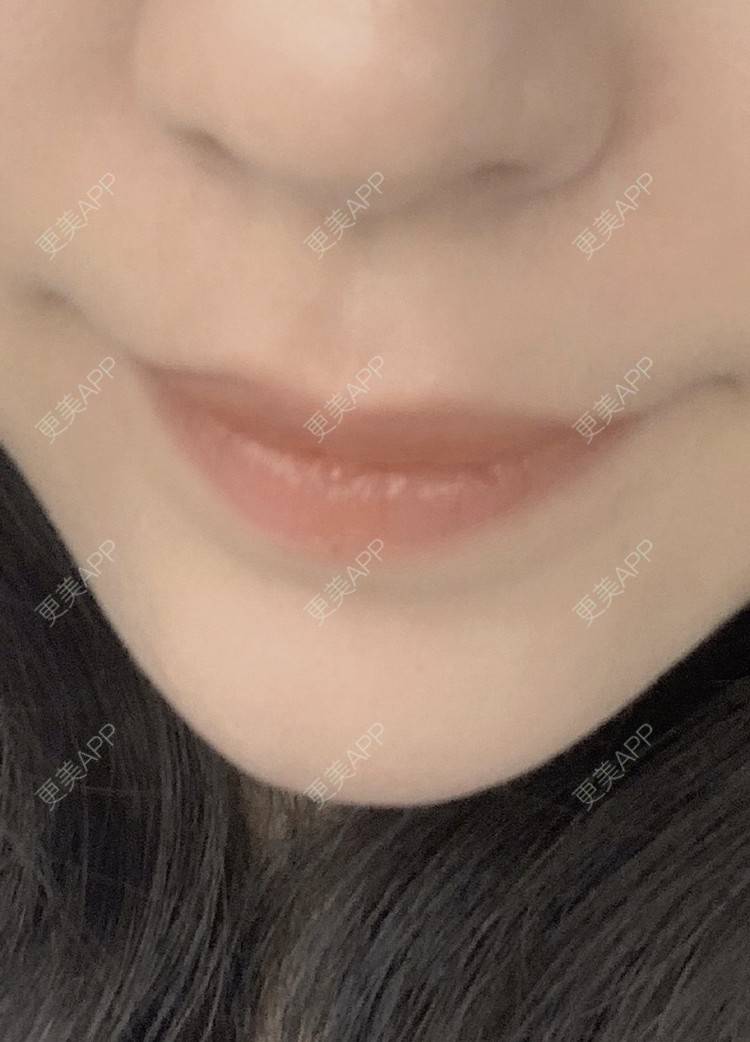更美 - 蒋幺Jocelyn的面部脱毛经验 | 面部脱毛 | 脱唇毛 | 激光脱腋毛 | 手臂脱毛 | 大腿脱毛