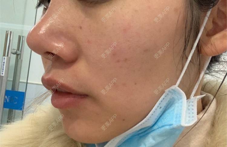 更美 - 浃浃！的厚唇改薄经验 | 厚唇改薄 | 上海