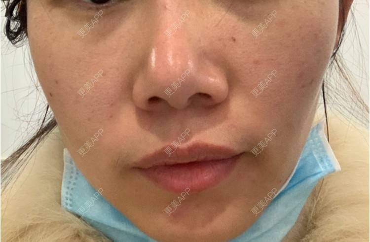 更美 - 浃浃！的厚唇改薄经验 | 厚唇改薄 | 上海