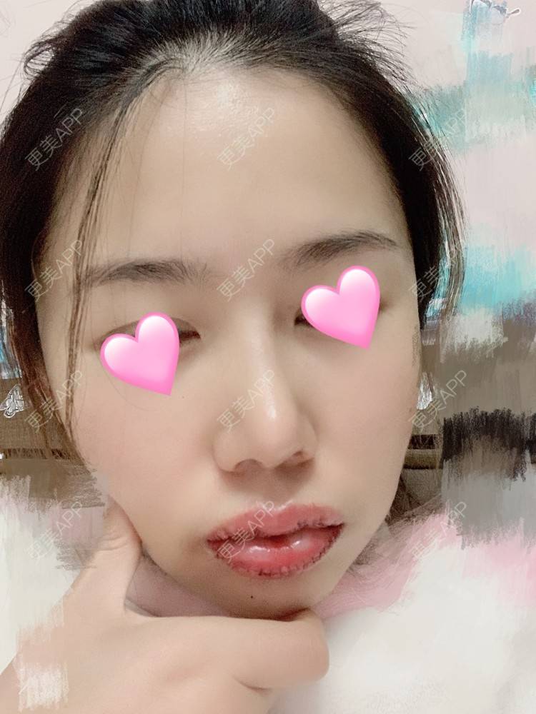 更美 - 浃浃！的厚唇改薄经验 | 厚唇改薄 | 上海