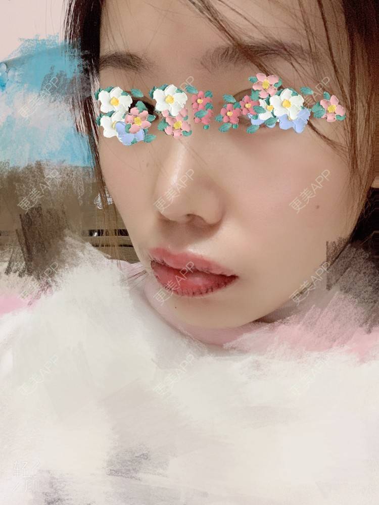 更美 - 浃浃！的厚唇改薄经验 | 厚唇改薄 | 上海