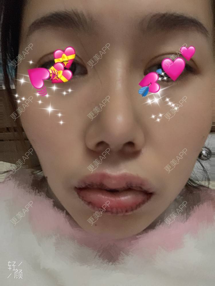 更美 - 浃浃！的厚唇改薄经验 | 厚唇改薄 | 上海